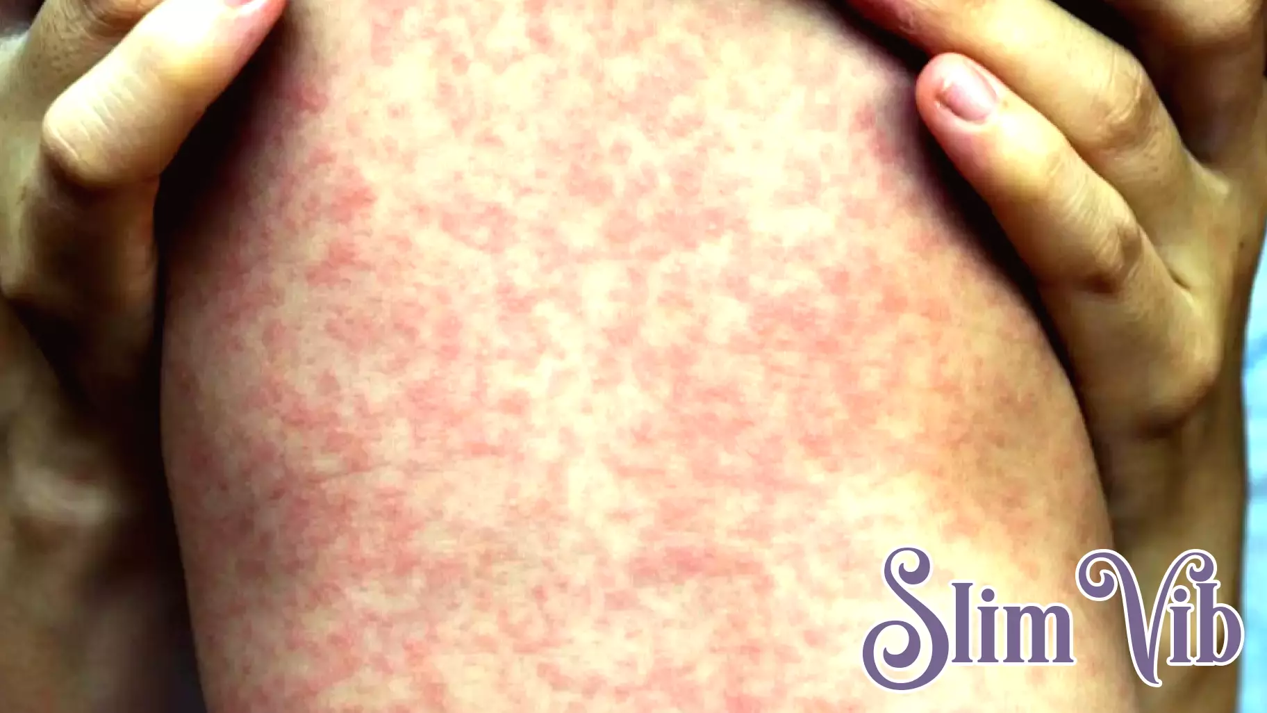 Measles Exposure Confirmed Following Soldier Hollow Event