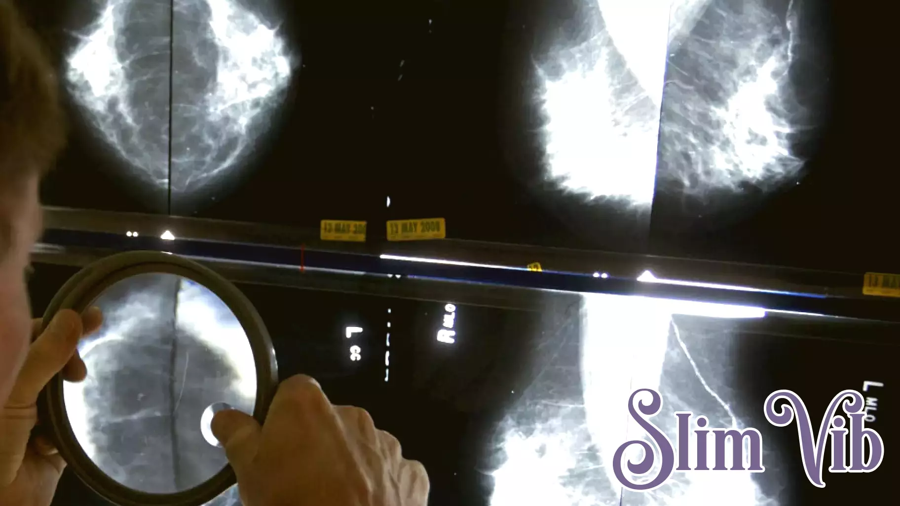 Revolutionizing Mammograms: AI's New Frontier in Health Diagnosis