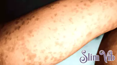 Health officials warn of new measles exposure site at Kaiser Mt. Scott in Clackamas