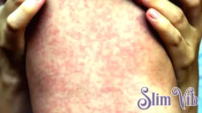 Measles Exposure Confirmed Following Soldier Hollow Event